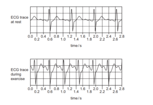 ECG traces at rest and during exercise