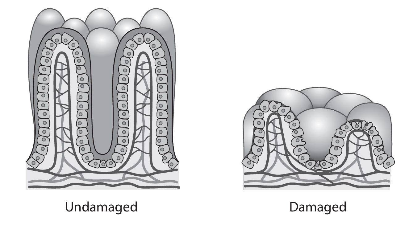 Healthy vs damaged villi diagram